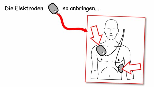 Herz-Druck-Massage: Die Elektroden anbringen